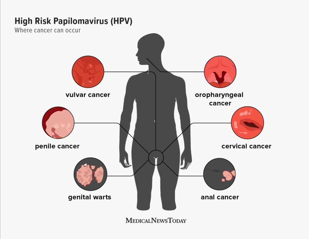 HPV Nedir, HPV Virüsü ve belirtileri nelerdir? Aşısı nedir, testi nasıl yapılır?