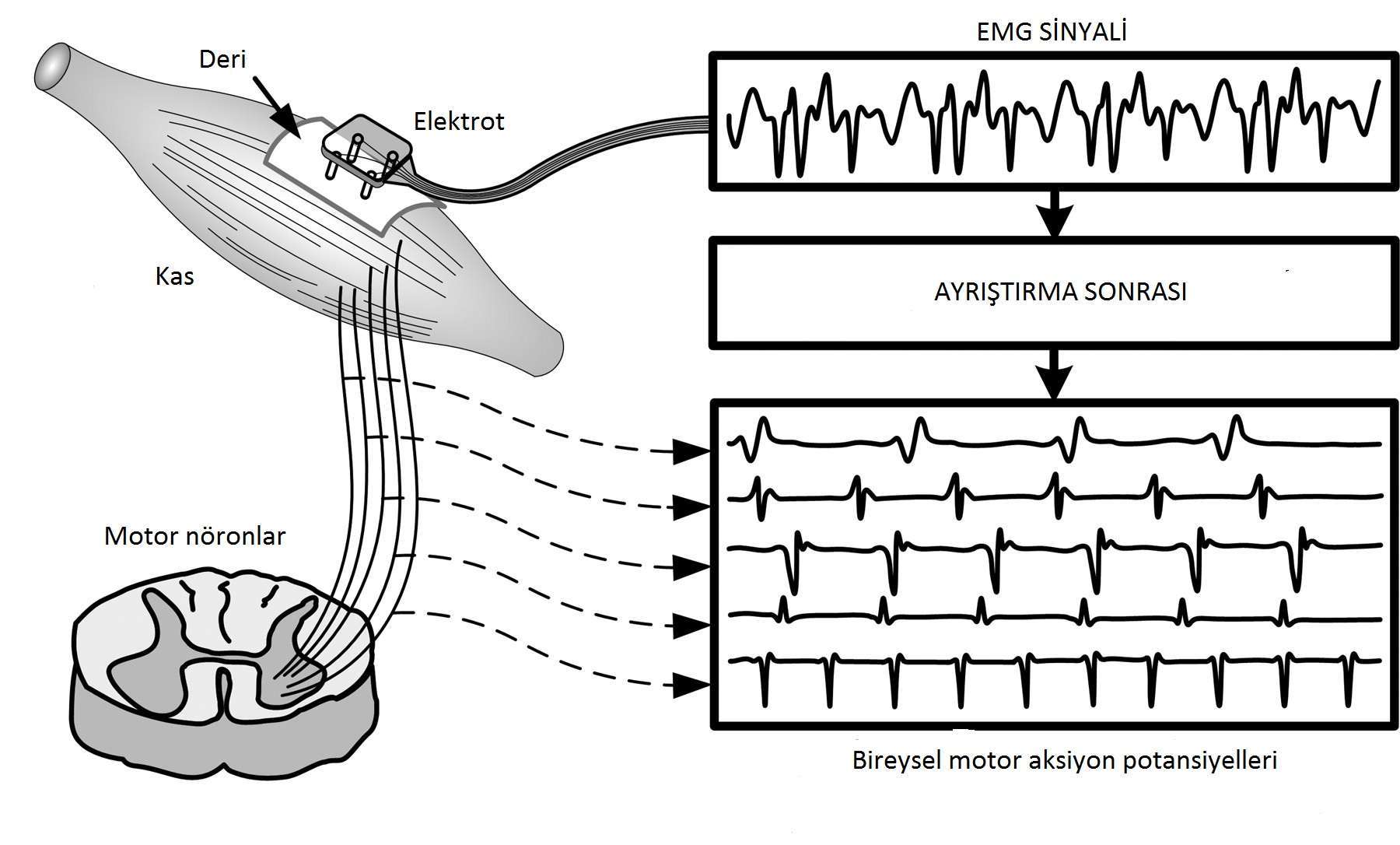 EMG Nedir, Ne İçin Çekilir, Nasıl Çekilir? EMG Testi, Aleti ve Açılımı