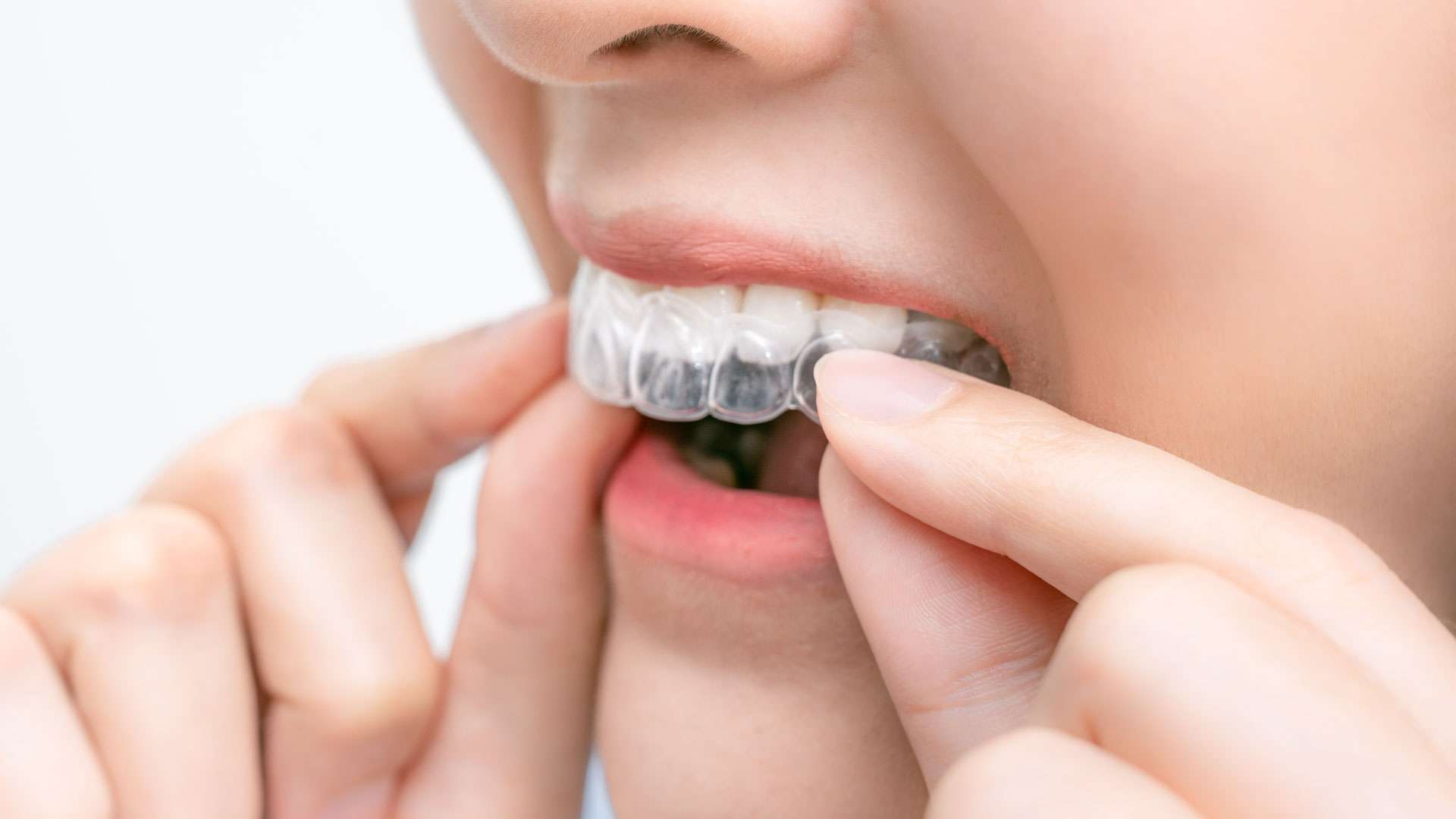Ortodonti Nedir? Ortondist Ne Demek, Ordotonti Tedavisi ve Ücreti