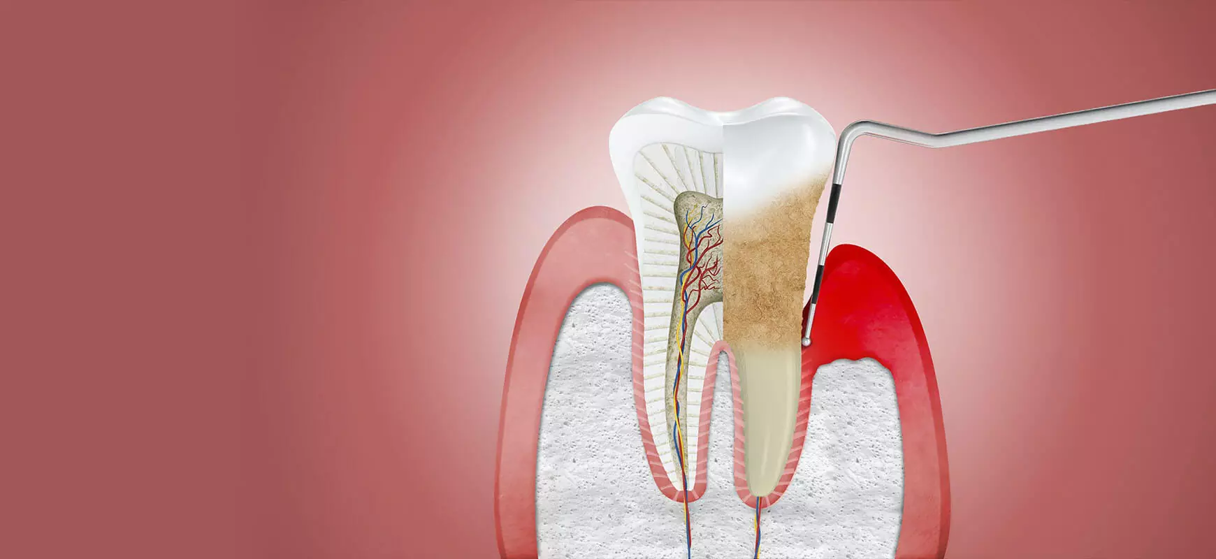 Periodontoloji Nedir? Diş Hastalıkları ve Tedavileri