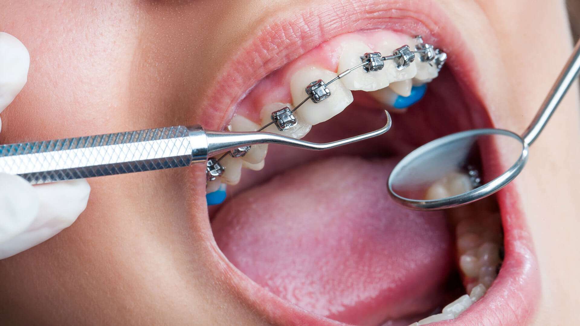 Periodontoloji Nedir? Periodontoloji Alanında Yapılan Tedaviler ve Çözümleri