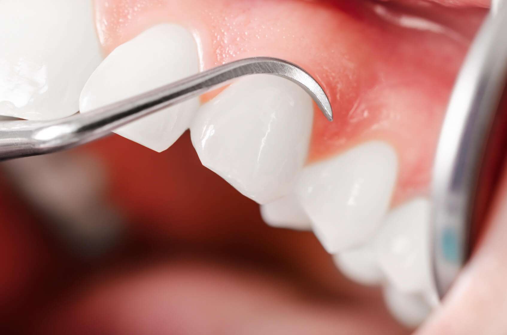 Periodontoloji Nedir, Ne Anlama Gelir, Nasıl Tedavi Edilir, Uzmanlaşma Süreci ve Çözümleri!