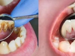 Periodontoloji Nedir? Periodontoloji Anlamı, Tanıtımı ve Hastalıkları!