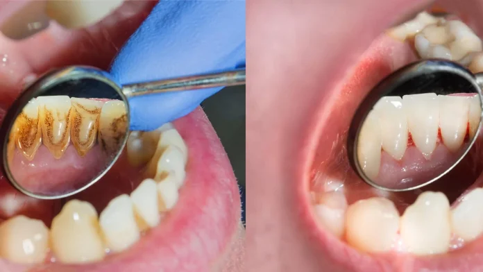 Periodontoloji Nedir? Periodontoloji Anlamı, Tanıtımı ve Hastalıkları!