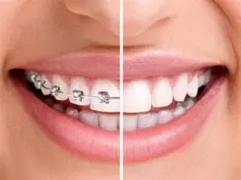 Ortodonti nedir?