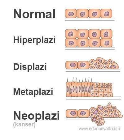 Hiperplazi nedir?