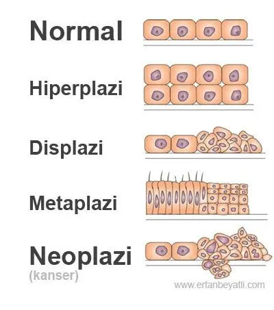 Hiperplazi nedir?